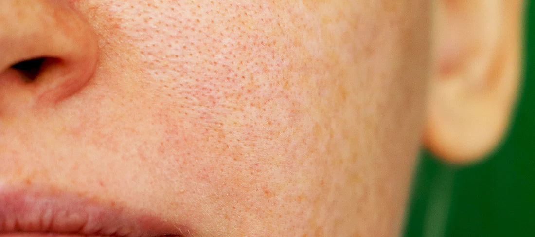 How to Unclog Your Pores