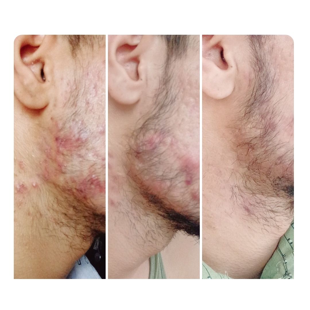 Acne And Spots Treatment Kit (PACK OF 4)