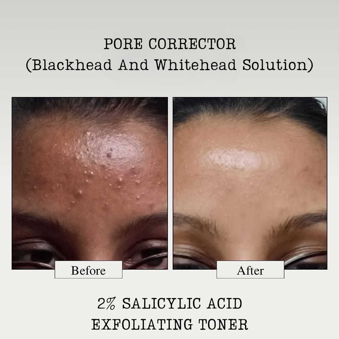 PORE CORRECTOR (Blackhead And Whitehead Solution)