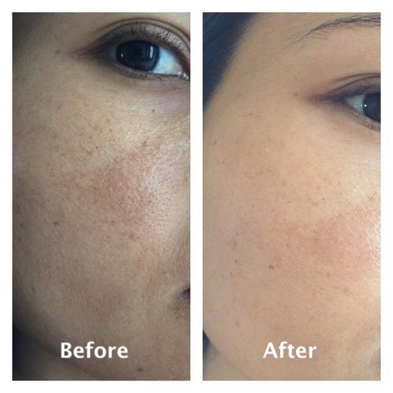 PORE MINIMISING BUNDLE OFFER (PACK OF 4)