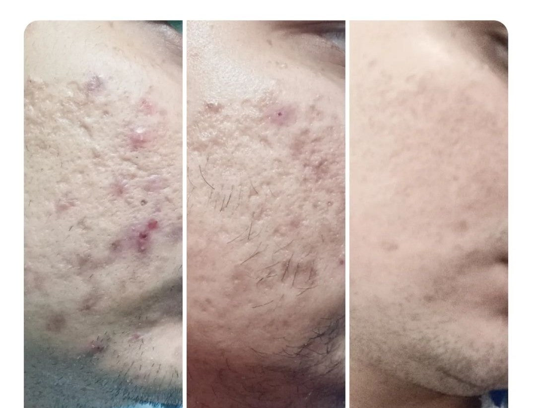 PORE MINIMISING BUNDLE OFFER (PACK OF 4)
