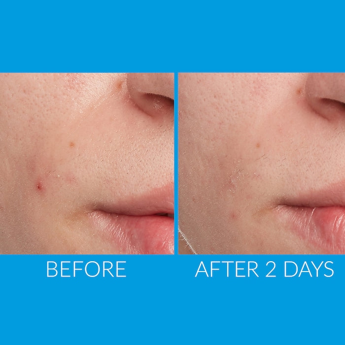 SALICYLIC ACID + GREEN TEA EXTRACT ACNE CLARIFYING GEL CLEANSER