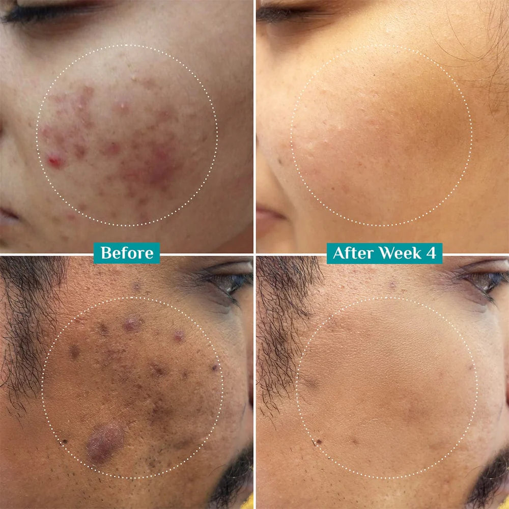 CLARIFYING ACNE SERUM (30 ml)