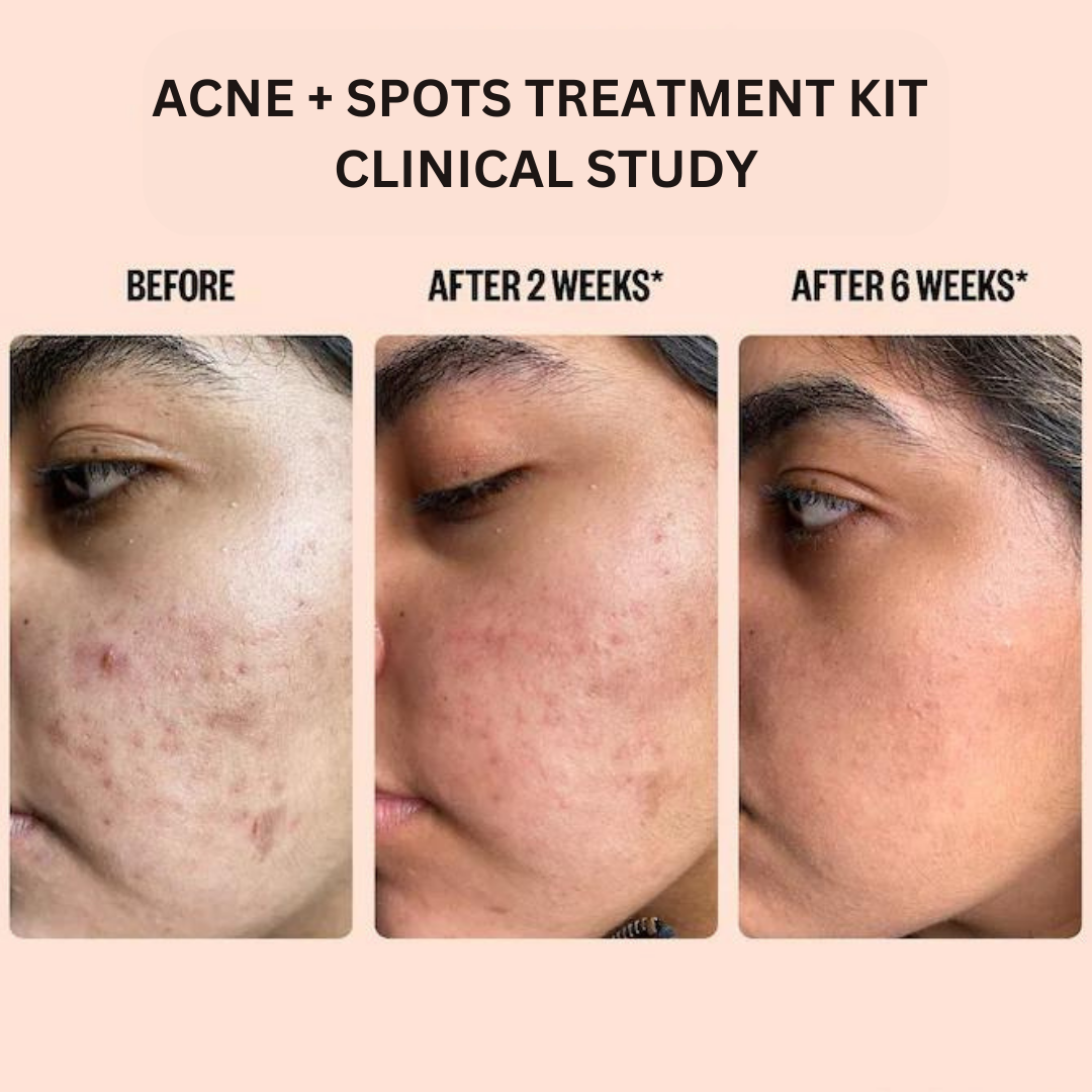 Spot Kit Acne And Spots Treatment Kit (PACK OF 4)