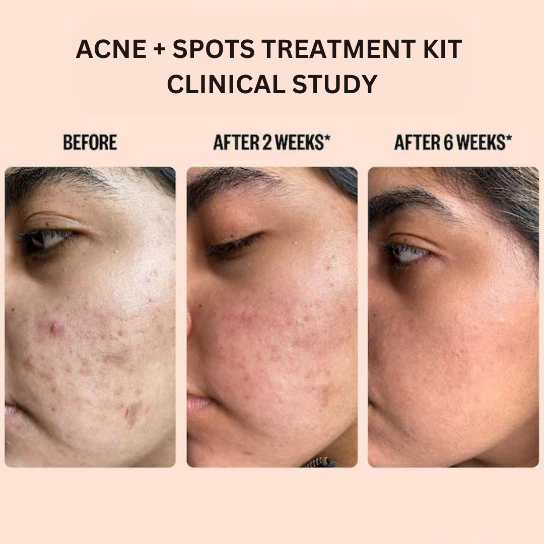 Acne And Spots Treatment Kit (PACK OF 4)