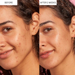 CLARIFYING ACNE SERUM (30 ml)