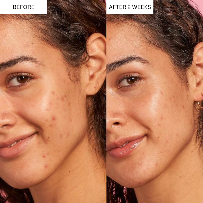 CLARIFYING ACNE SERUM (Treats All Kinds Of Acne And Marks)