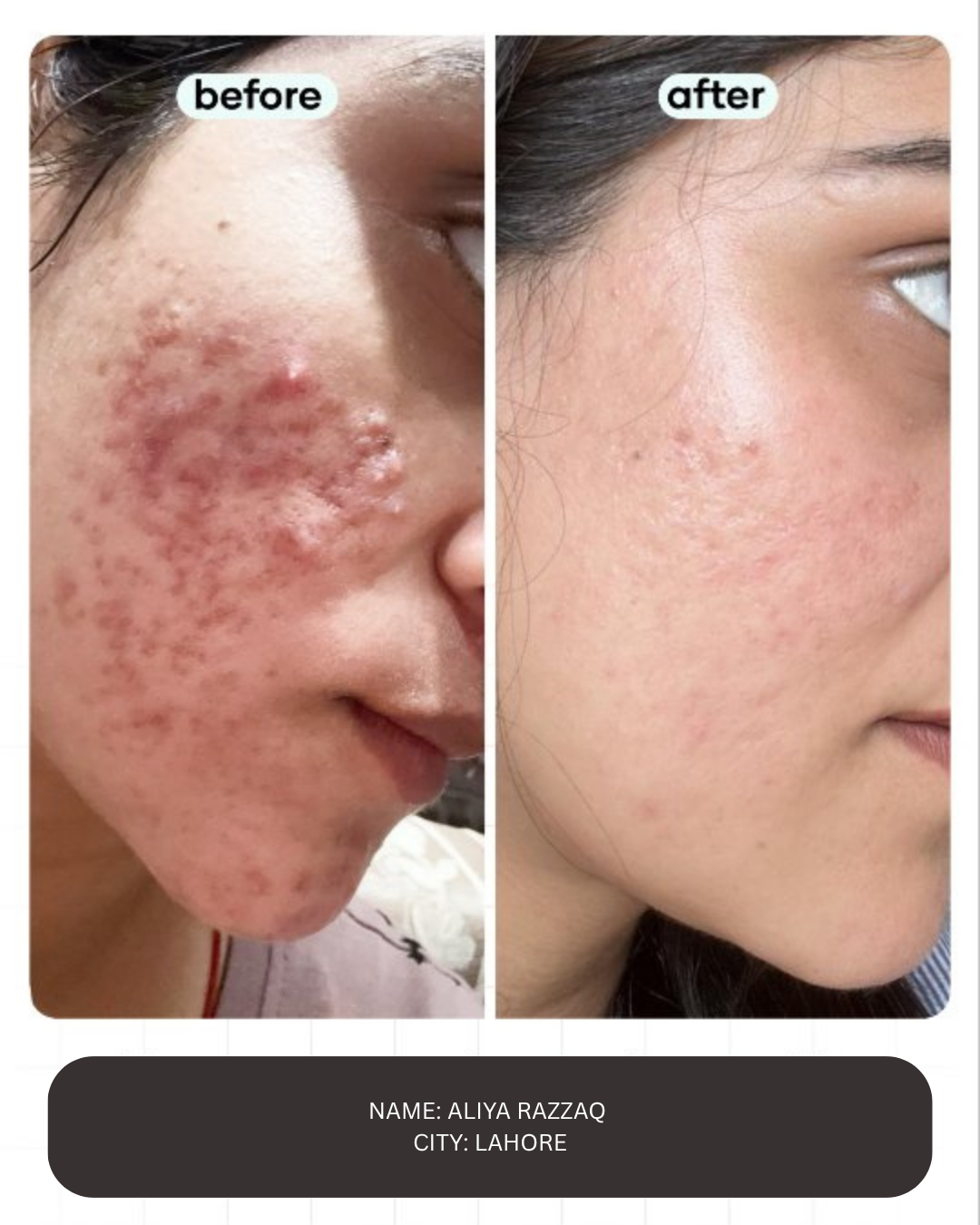 Acne And Spots Treatment Kit (PACK OF 4)