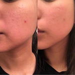 SALICYLIC ACID + GREEN TEA EXTRACTS ACNE CLEANSER (120 ml)