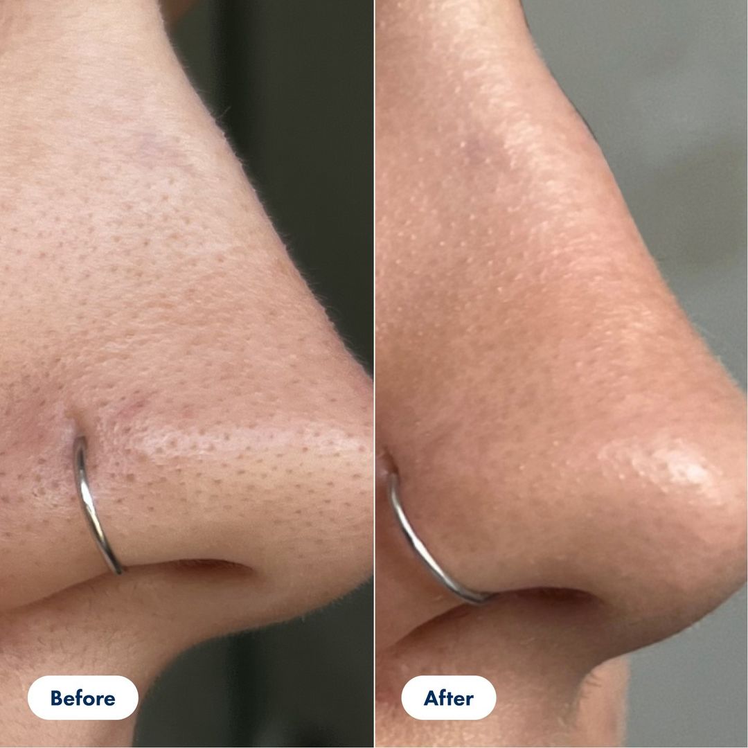 PORE CORRECTOR (Blackhead And Whitehead Solution)