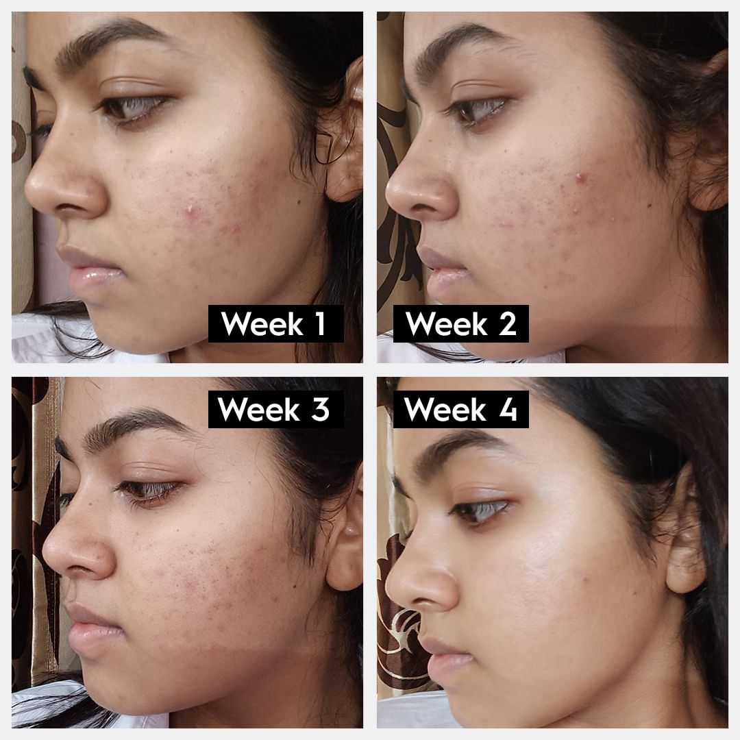 CLARIFYING ACNE SERUM (Treats All Kinds Of Acne And Marks)