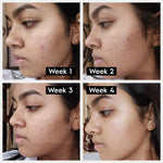 CLARIFYING ACNE SERUM (30 ml)
