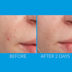 SALICYLIC ACID + GREEN TEA EXTRACTS ACNE CLEANSER (120 ml)