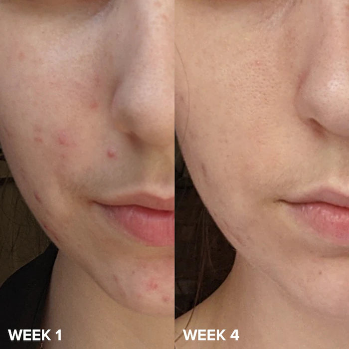 CLARIFYING ACNE SERUM (Treats All Kinds Of Acne And Marks)