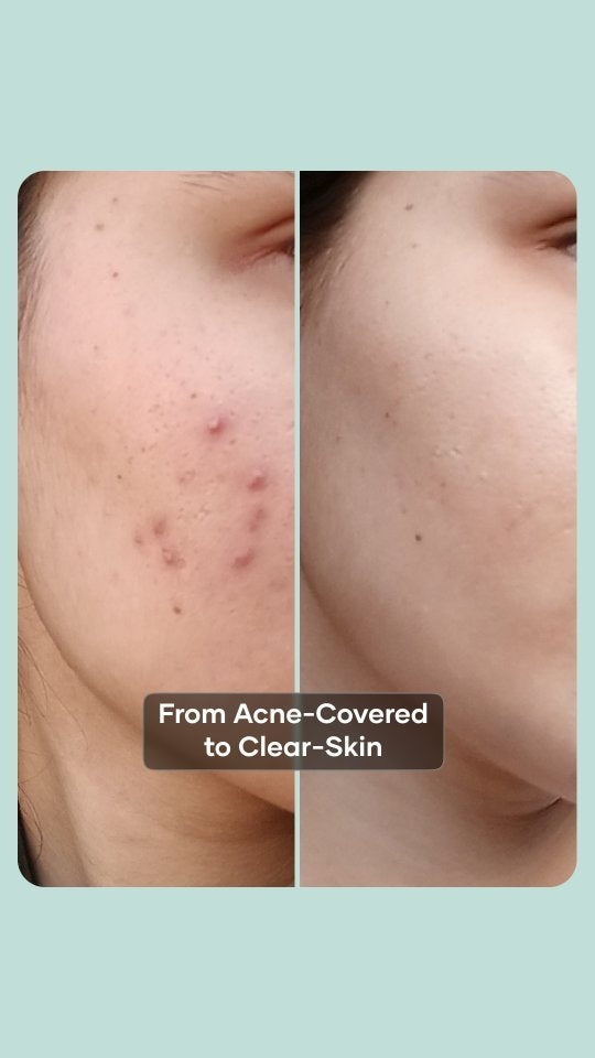 ACNE + PIGMENTATION BUNDLE (PACK OF 3)